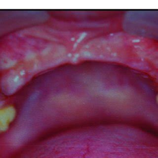 An Intraoral Photograph Showing The Maxillary Arch With Right And Left