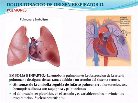 Dolor Toracico PPT Descarga Gratuita