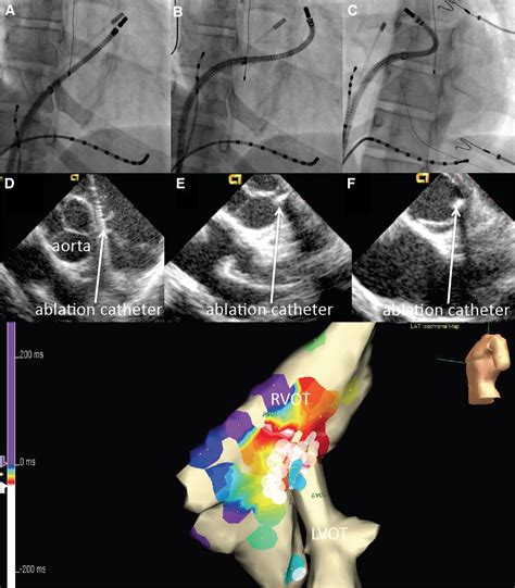 Robotic Catheter Ablation Of Left Ventricular Tachycardia Initial