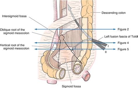 Laparoscopic Sigmoidectomy | Abdominal Key