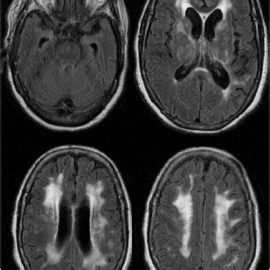 Imaging: Brain MRI repeatedly showed extensive abnormalities in the ...