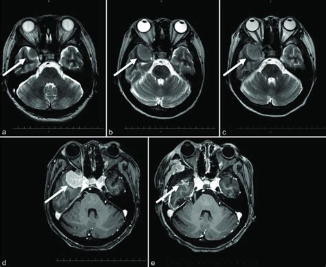 Preoperative T Weighted Magnetic Resonance Imaging Mri Performed At