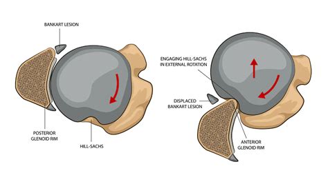 Hillsacks Lesion Dr Rahul Bade