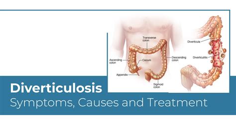 Diverticulosis What It Is Symptoms Causes Treatment