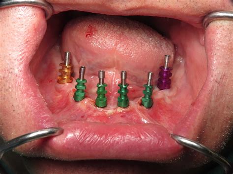 Dental Implant Rings At Katherine Lew Blog