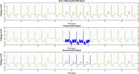 U-wave locations and their polarities in ECG signal | Download ...