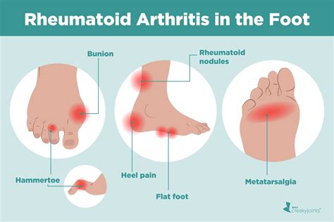 Arthritis in legs – Artofit