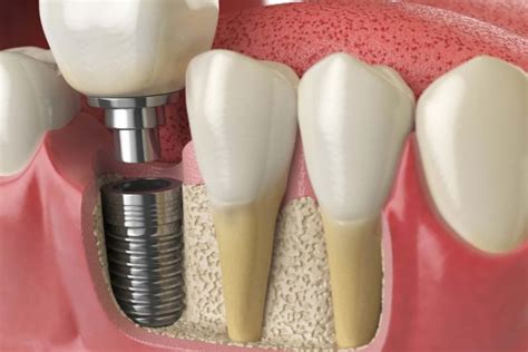 Techniques And Treatment For Your First Dental Implant Procedure