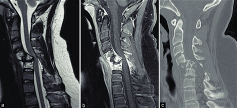 Preoperative sagittal T2-weighted (a) MRI demonstrates severe ...