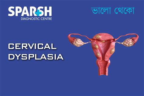 Cervical Dysplasia Causes Symptoms Diagnosis And Treatment Sparsh