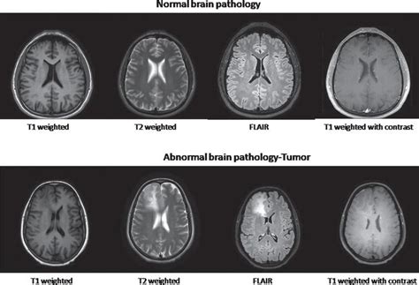 Abnormal Brain CT Scan