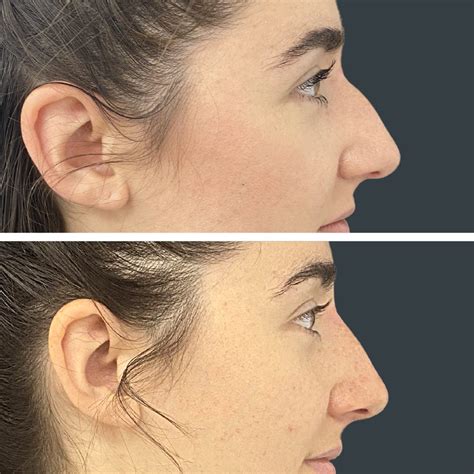 Non Surgical Rhinoplasty Nose Shaper Nose Filler Or Hiko Nose Thread