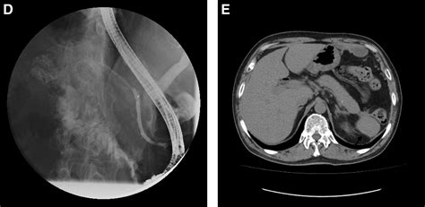 Pancreatic Duct Disruption With Autosplenectomy Gastroenterology