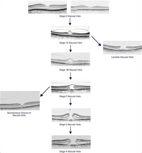 macular hole Optometry Students, Optometry School, Eye Health Facts ...