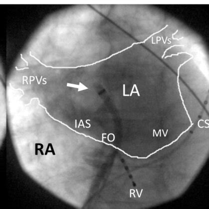 The Figure Illustrates The Anatomic Landmarks For A Transseptal