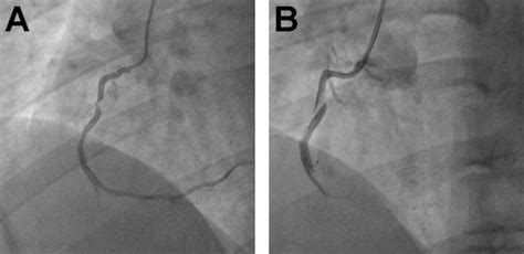 The Novel Use Of Retrograde CTO PCI Techniques As A Rescue Strategy For