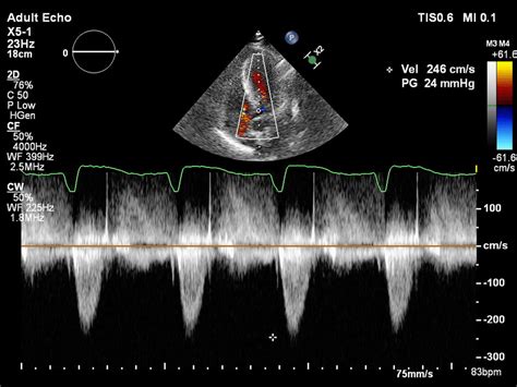 Postoperative Transthoracic Echocardiography Which Demonstrated A