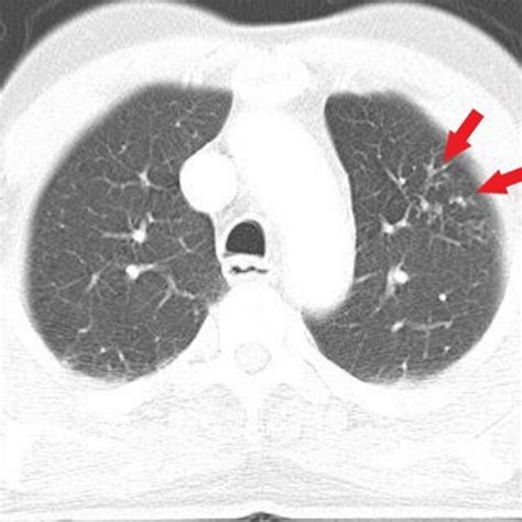 Pulmonary Nodule Centrilobular Nodules In Left Upper Lobe With Tree In