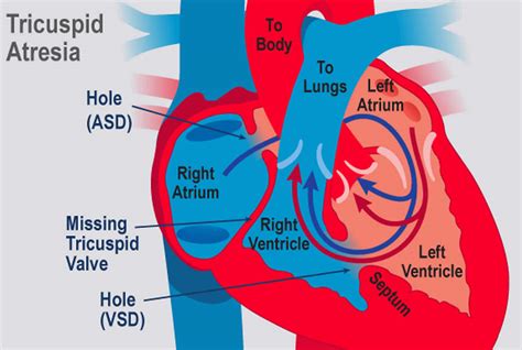 Tricuspid Atresia Causes Symptoms Diagnosis Treatment Prognosis