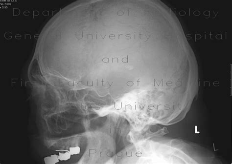 Radiology case: Fracture of dens axis