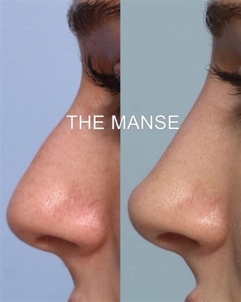 Nose Filler Non Surgical Rhinoplasty At Our Expert Sydney Clinic