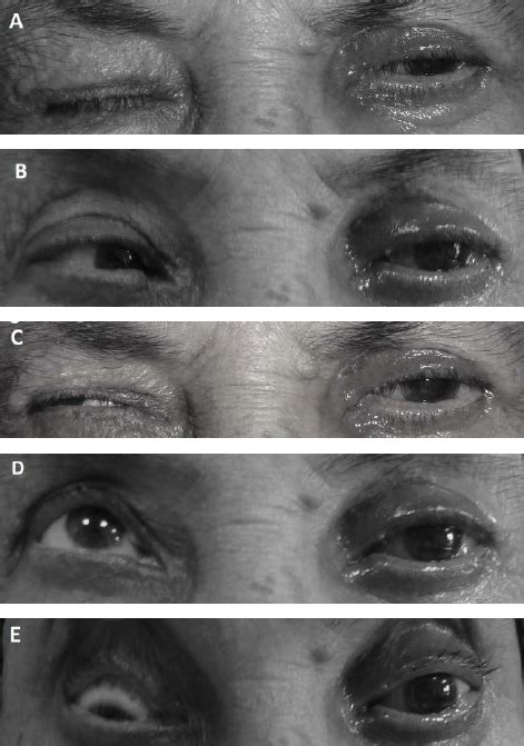 A ) The patient presented with lagophthalmos and frozen | Download Scientific Diagram