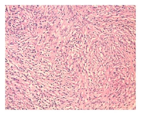 Circumscribed Spindle Cell Tumor Composed Of Interlacing Fascicles With