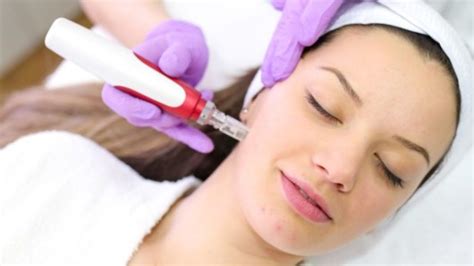 What Is Microneedling Radiofrequency Its Benefits And Application Top Me