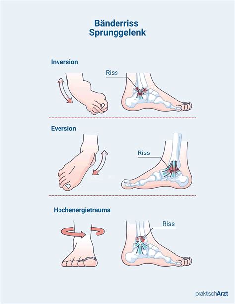 Bänderriss Sprunggelenk Ursachen Behandlung