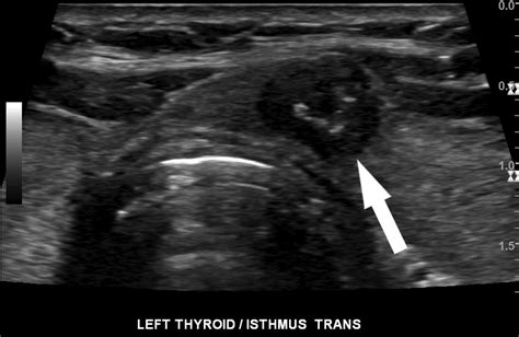 Isthmus Thyroid Ultrasound