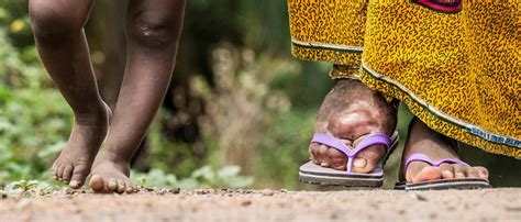 Lymphatic Filariasis Elephantiasis