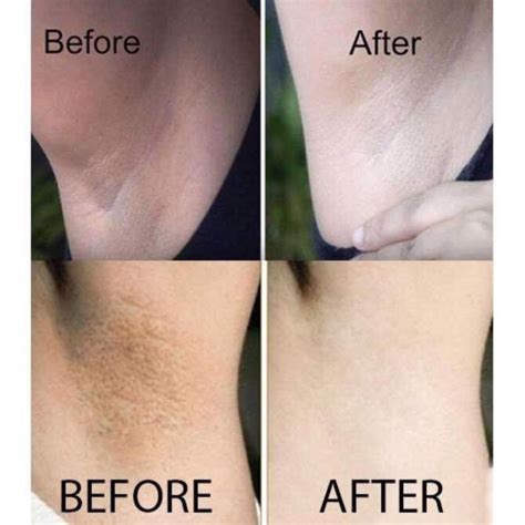 Kem Nuwhite hồng nhũ hoa N1 hồng bikini V1 trị thâm nách H6 môi L1A TIẾN THÀNH BEAUTY