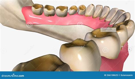 Dental Erosion, Also Known As Tooth Erosion Stock Illustration ...