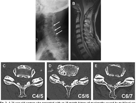 Figure 2 From Pathophysiology Of Calcification And Ossification Of The