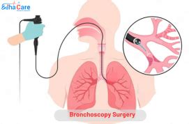 Bronchoscopy | Bronchoscopy Surgery | bronchoscopy biopsy