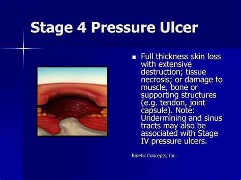 Stage 1 Pressure Ulcer Sacrum