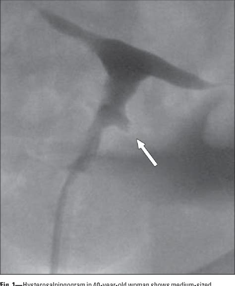 Figure 1 From Cesarean Section Scar Diverticulum Appearance On