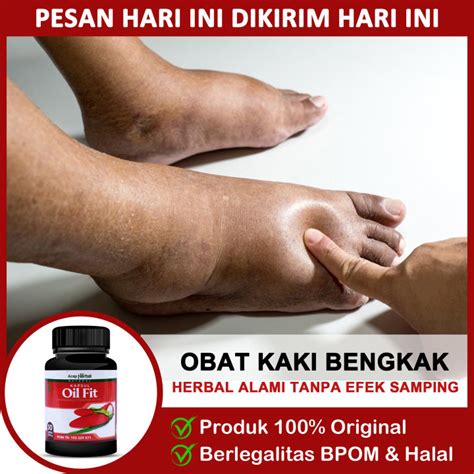 Obat Kaki Bengkak Akibat Asam Urat Diabetes Jantung Kaki Terkilir