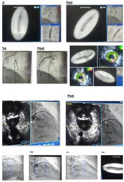 Ivl Under Ivus Guidance For Under Deployed Stent Failure Journal Of