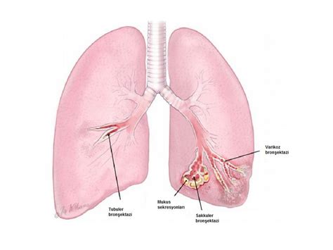 Mild Cylindrical Bronchiectasis Comprehensive Guide To Treatment