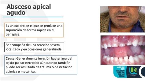 Absceso apical agudo y crónico