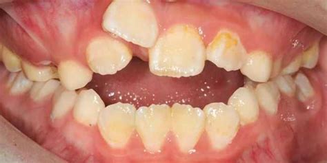 Familiarize Se Problemas Comuns De Dentes E Dicas Para Higiene