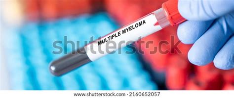 101 Multiple Myeloma Blood Test Stock Photos, Images & Photography | Shutterstock