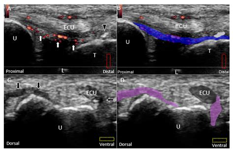 Ulnar Wrist Pain Revisited Ultrasound Diagnosis And Guided Injection