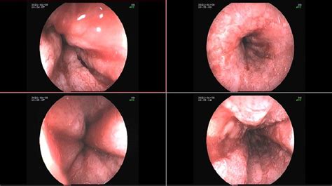 Endoscopic Examination Of Herpes Esophagitis Showing Multiple Ulcers