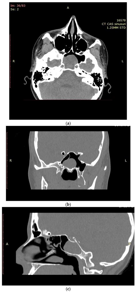 Medicina Free Full Text Management Of Capillary Hemangioma Of The