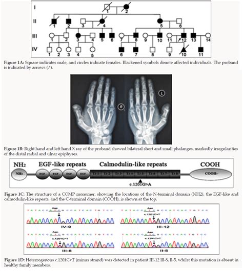 Whole Exome Sequencing Reveals A Recurrent D401n Mutation In The Comp