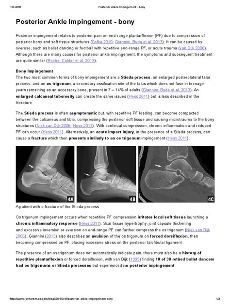 Posterior Ankle Impingement Bony Rayner And Smale Pdf Pdf Ankle