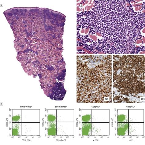 A A Punch Biopsy Specimen Of A Scalp Lesion In Patient 2 Revealed A