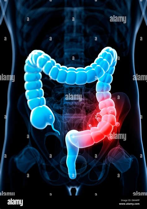 Diverticulosis Of Colon Hi Res Stock Photography And Images Alamy